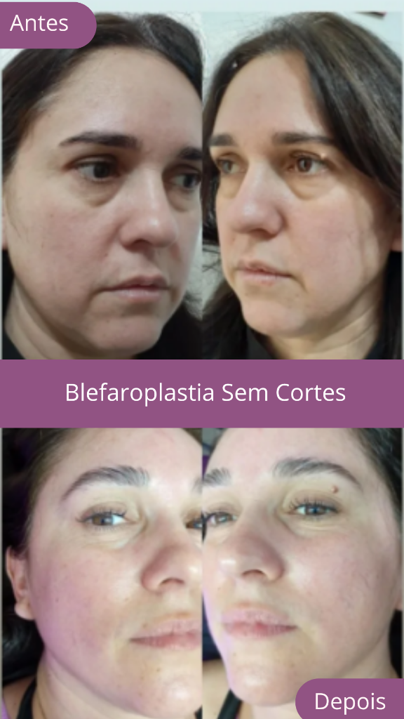 Blefaroplastia Result 1